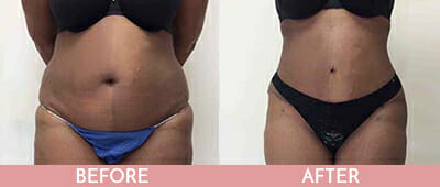 Tummy Tuck Before and After, Montclair, NJ and New York (NY)