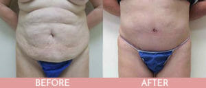 Tummy Tuck Gallery
