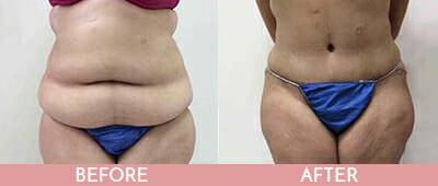 Tummy Tuck Before and After, Montclair, NJ and New York (NY)