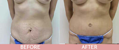 Tummy Tuck Before and After, Montclair, NJ and New York (NY)