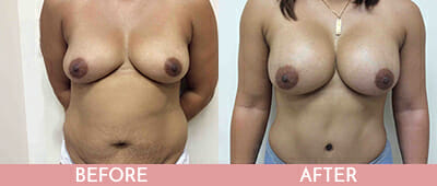 Tummy Tuck Before and After, Montclair, NJ and New York (NY)