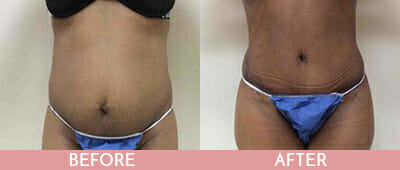 Tummy Tuck Before and After, Montclair, NJ and New York (NY)