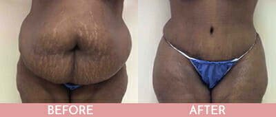 Tummy Tuck Before and After, Montclair, NJ and New York (NY)