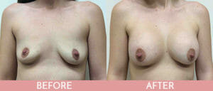 Breast Augmentation Gallery