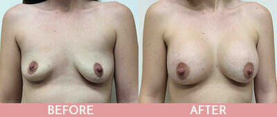 Breast Augmentation Before and After, Montclair, NJ and New York (NY)