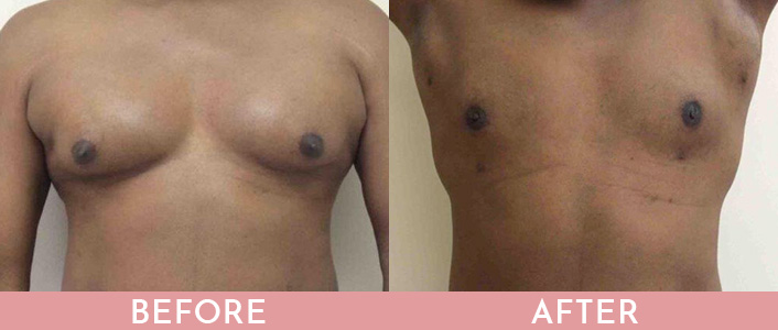 Gynecomastia Correction (Male Breast Reduction) in NY and NJ