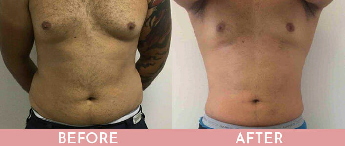 Liposuction Before and After, Montclair, NJ and New York (NY)
