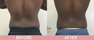 SculpSure® WarmSculpting™ Before and After, Montclair, NJ and New York (NY)