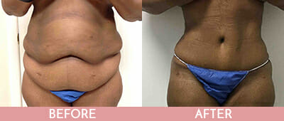 Tummy Tuck Before and After, Montclair, NJ and New York (NY)