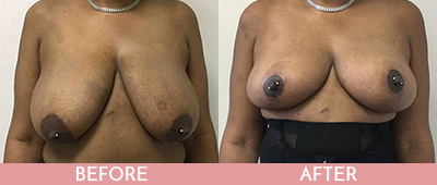Breast Lift Before and After, Montclair, NJ and New York (NY)