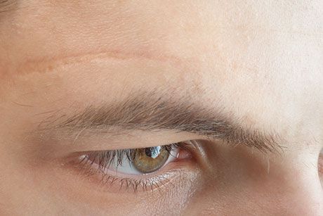 Scar Revision Treatments Example