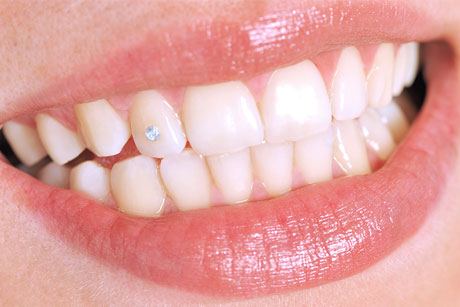 Tooth Gems Example of a Smile