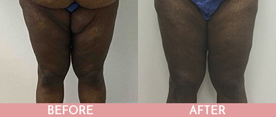 Thigh Lift Before and After, Montclair, NJ and New York (NY)