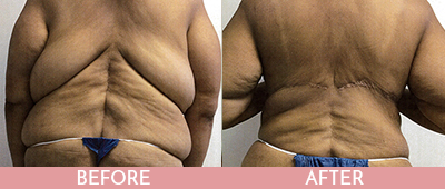 Back Lift Before and After, Montclair, NJ and New York (NY)