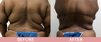 Back Lift Before and After, Montclair, NJ and New York (NY)