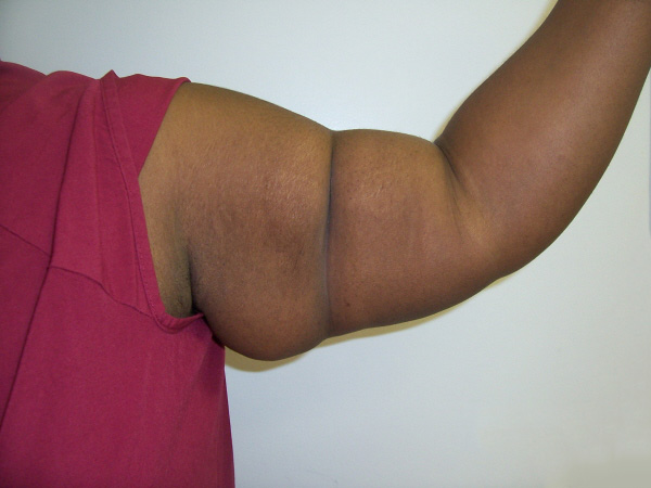 Before Arm Lift