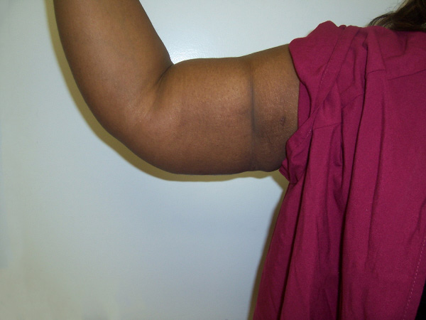After Arm Lift