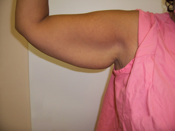 Before Arm Lift