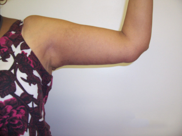 After Arm Lift