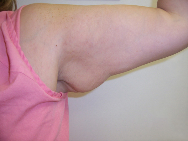 Before Arm Lift