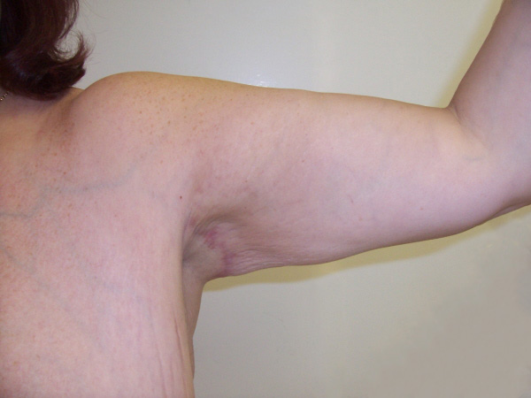 After Arm Lift