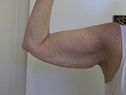 Before Arm Lift