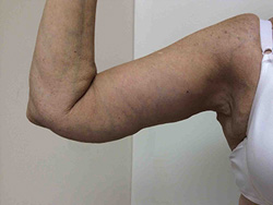 After Arm Lift