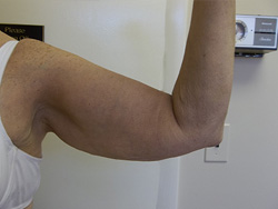 Before Arm Lift