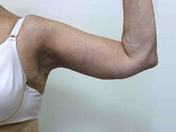 After Arm Lift