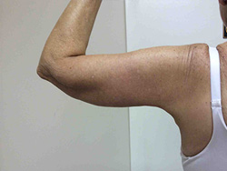 After Arm Lift