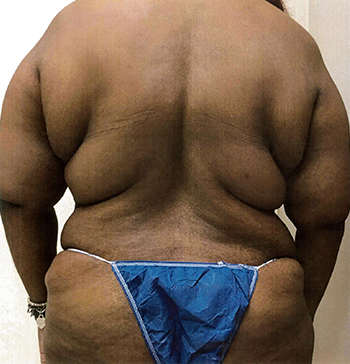 Before Back Lift