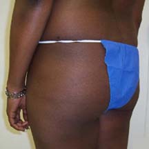 Before Brazilian Butt Lift