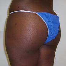 After Brazilian Butt Lift