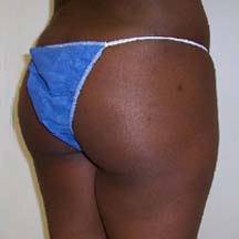 After Brazilian Butt Lift