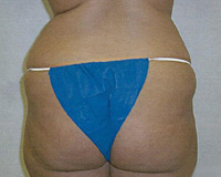 Before Brazilian Butt Lift