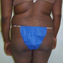Before Brazilian Butt Lift