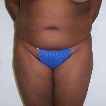 Before Brazilian Butt Lift