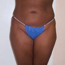 After Brazilian Butt Lift