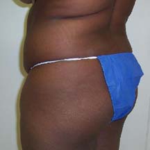 Before Brazilian Butt Lift