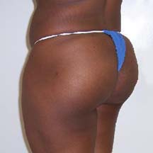 After Brazilian Butt Lift