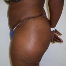 After Brazilian Butt Lift