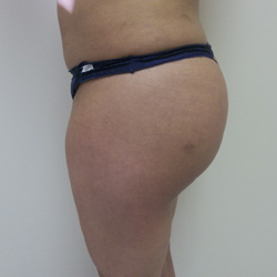 After Brazilian Butt Lift