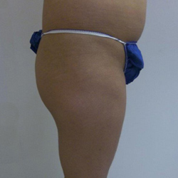 Before Brazilian Butt Lift