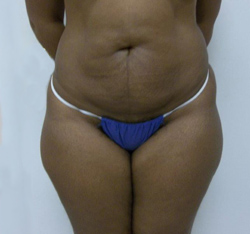 Before Brazilian Butt Lift