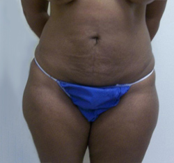 After Brazilian Butt Lift