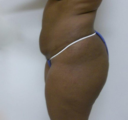 Before Brazilian Butt Lift