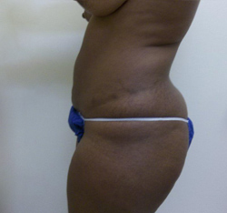 After Brazilian Butt Lift