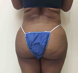 After Brazilian Butt Lift