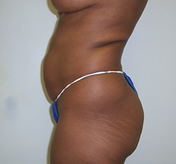 Before Brazilian Butt Lift