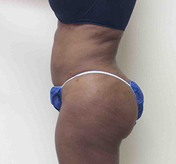 After Brazilian Butt Lift